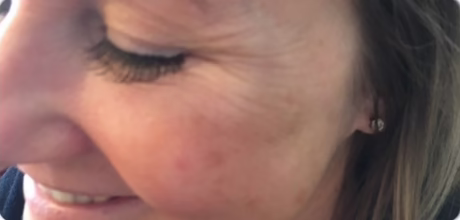 after crows feet anti wrinkle treatment showing smoother skin timeless treatments manchester