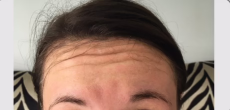 before forehead lines treated at timeless treatments aesthetic clinic in manchester