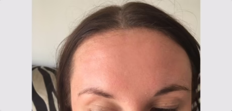 after forehead wrinkle injections result timeless treatments manchester