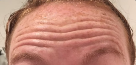 before photo of forehead wrinkles timeless treatments beauty clinic manchester