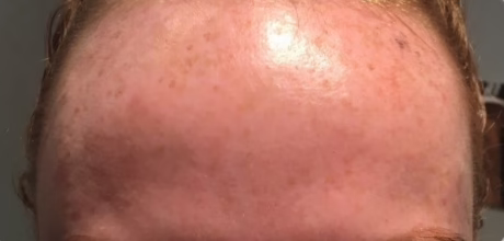 visible improvement after forehead anti wrinkle procedure timeless treatments manchester