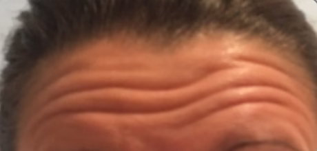 forehead wrinkle smoothening after anti wrinkle injections timeless treatments manchester