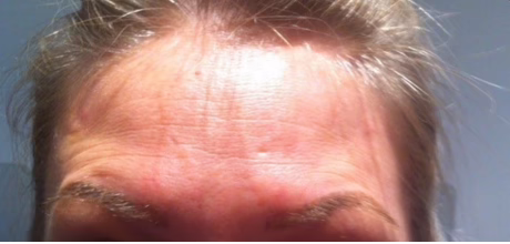 after forehead anti wrinkle treatment smooth skin timeless treatments beauty clinic manchester