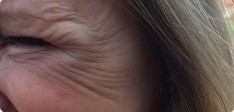 before crows feet anti wrinkle injections at timeless treatments manchester aesthetic clinic