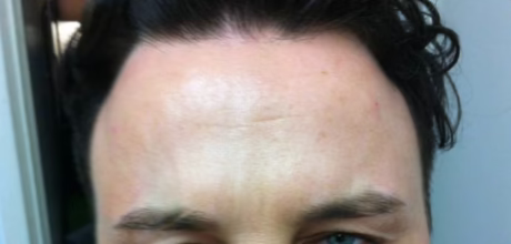 after botox forehead treatment timeless treatments manchester