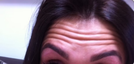 before forehead wrinkle treatment timeless treatments aesthetic clinic manchester