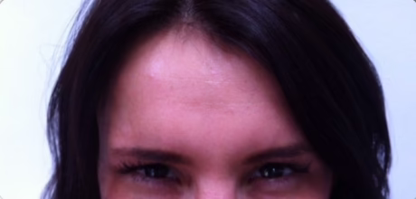 after forehead anti wrinkle procedure with visible line reduction timeless treatments manchester