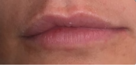 after lip filler treatment for natural volume timeless treatments beauty clinic manchester