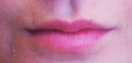 before lip augmentation timeless treatments aesthetic clinic manchester