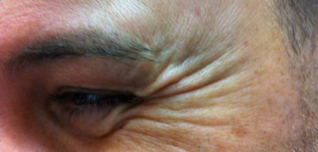 before treatment close up of eye wrinkles at timeless treatments aesthetic clinic manchester