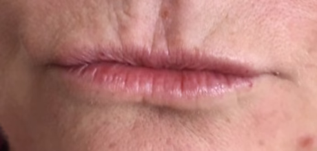 before dermal filler applied to lips timeless treatments manchester