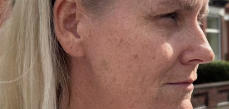 after cheek filler for lifted contour timeless treatments manchester