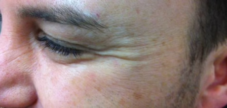 after anti wrinkle injection for crows feet with visible improvement timeless treatments manchester