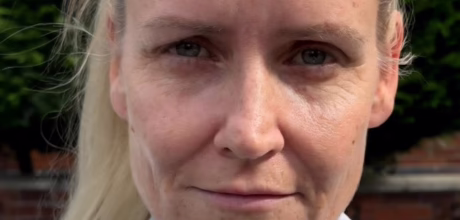 after cheek filler for lifted contour timeless treatments manchester