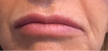 after skin booster for smoker lines timeless treatments manchester