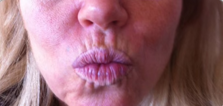 before fine line reduction around mouth timeless treatments manchester