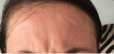 before frown lines anti wrinkle injection at timeless treatments beauty clinic manchester