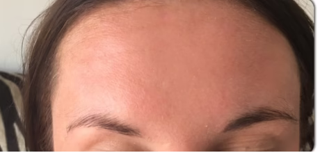 after frown lines anti wrinkle injection timeless treatments aesthetic clinic manchester
