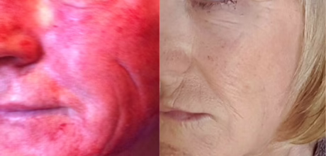 after vampire therapy prp facial glowing rejuvenated skin timeless treatments beauty clinic manchester