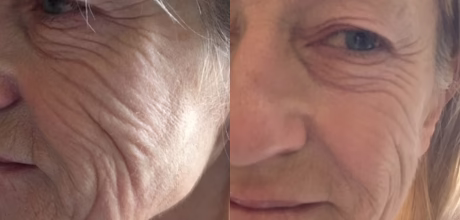 before prp vampire facial showing dull skin timeless treatments aesthetic clinic manchester